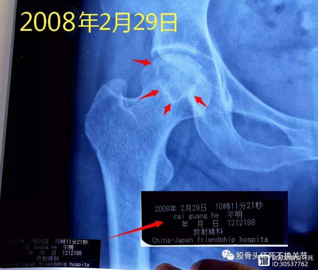 三亚人工骨头医保报销多少(人工骨头医保报销多少比例)